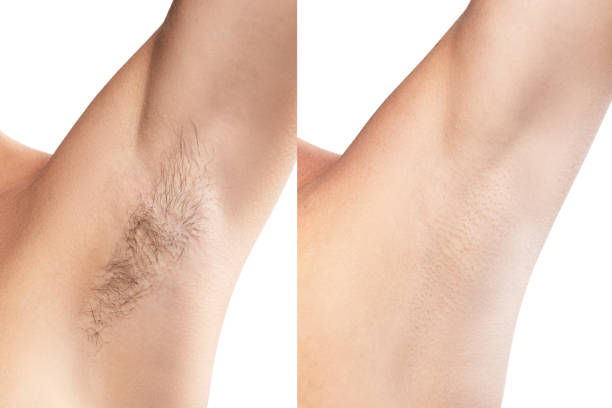 You are currently viewing Pourquoi l’épilation long terme est-elle une solution durable ?